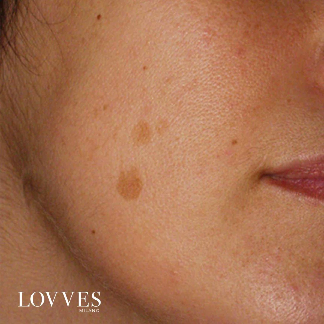 Lovves Sérum Aclarante Manchas Faciales Despigmentante - Image 4